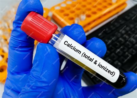 calcium blood test bottle colour|ionized calcium blood test.